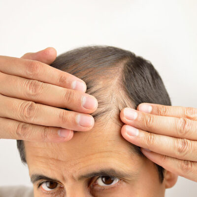 9 common causes of hair loss