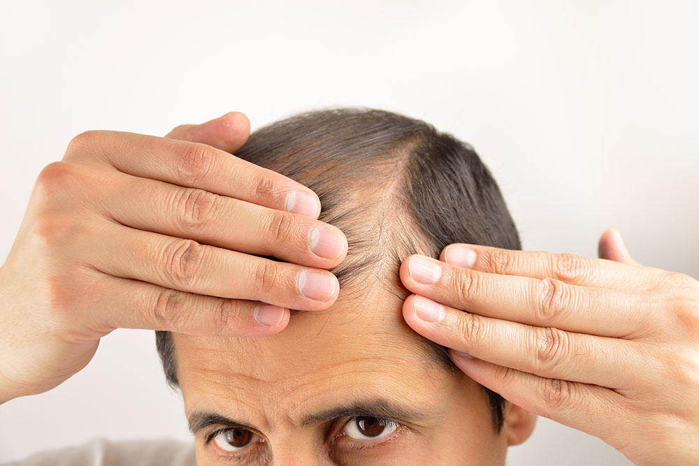 9 common causes of hair loss