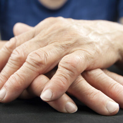 An overview of rheumatoid arthritis treatments
