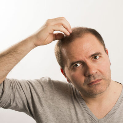 Best products in the market to control male pattern baldness