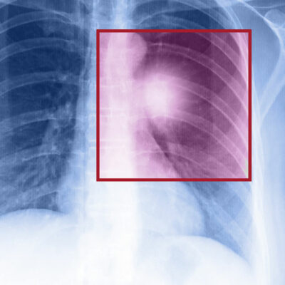 Treatment options for non-small cell lung cancer