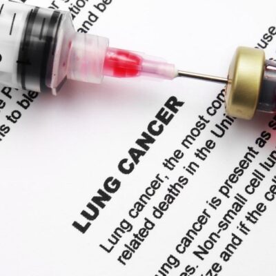 Symptoms of Lung Cancer That Can’t Be Ignored