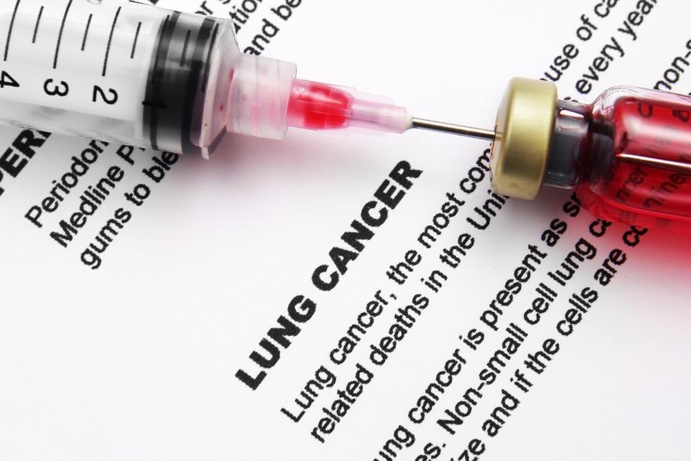 Symptoms of Lung Cancer That Can’t Be Ignored