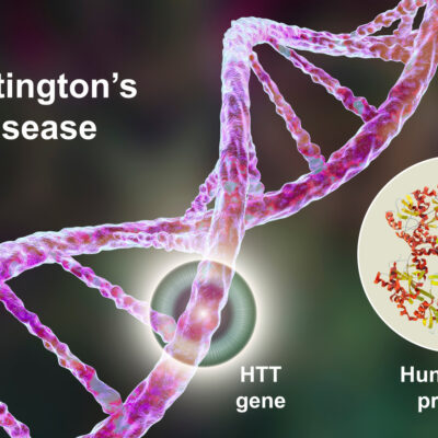 The Primary Cause Of Huntington’s Chorea
